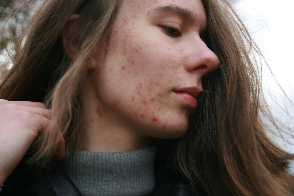 Chronic Inflammation: How to Know If You Have It, Foods That Reduce It, and How to Heal Your Gut Naturally - The Hackers Market